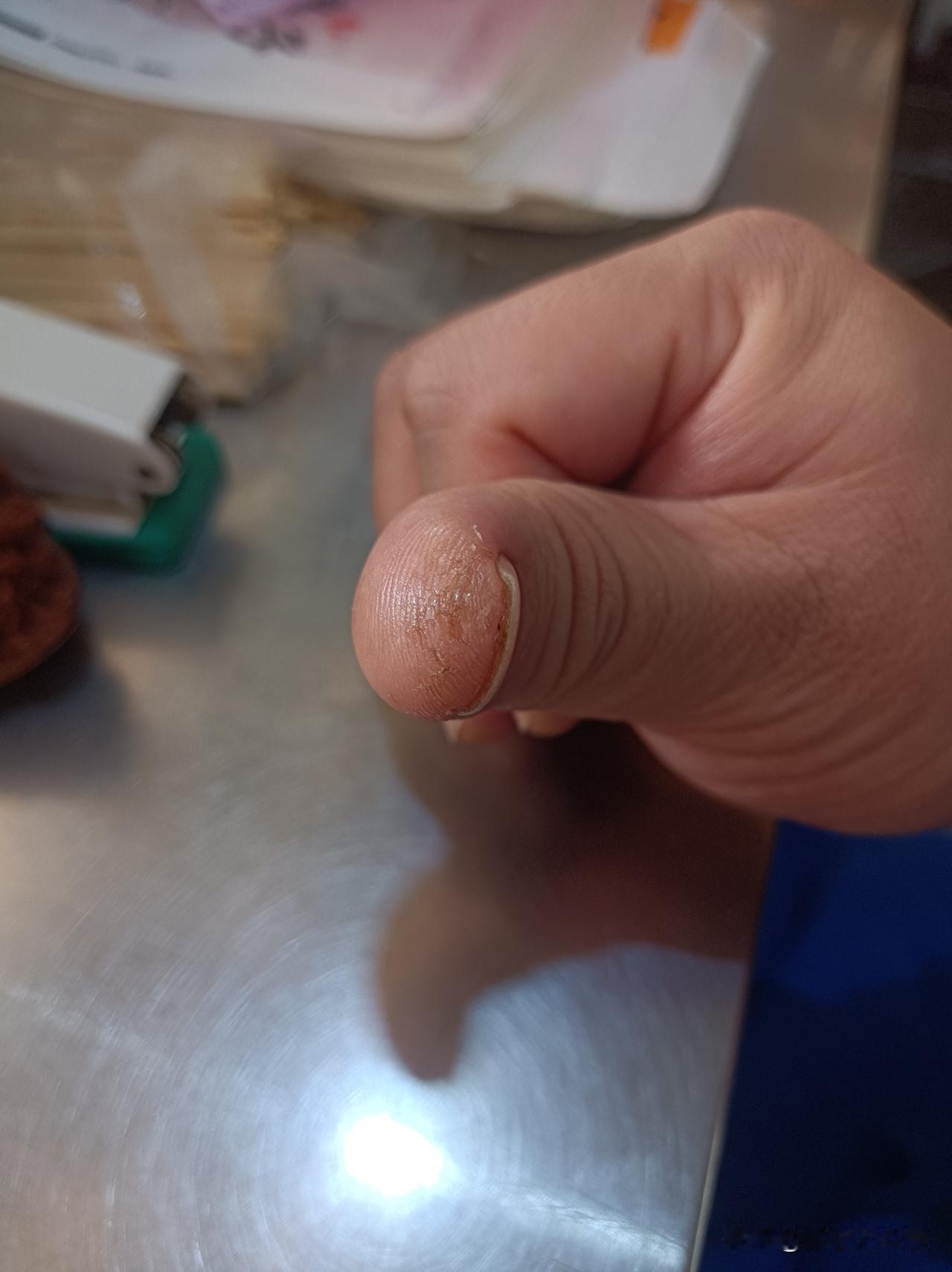 还得是国货大拇哥好几年了，到冬天就裂口子，很深的口子。因为工作需要老是抓面粉