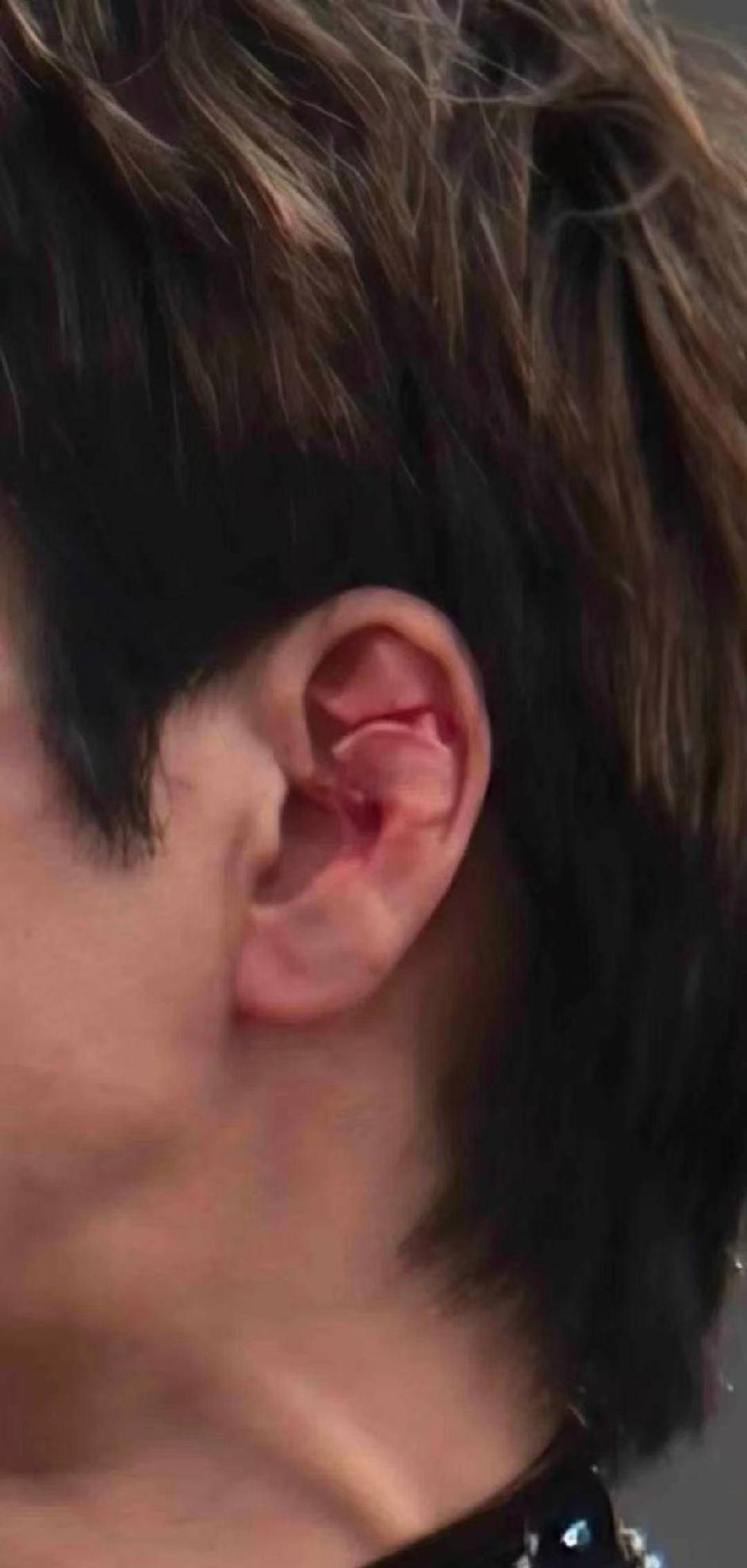 王力宏真是被害惨了！耳软骨都被割裂了，还继续唱，不是他不痛，而是他太害怕了。