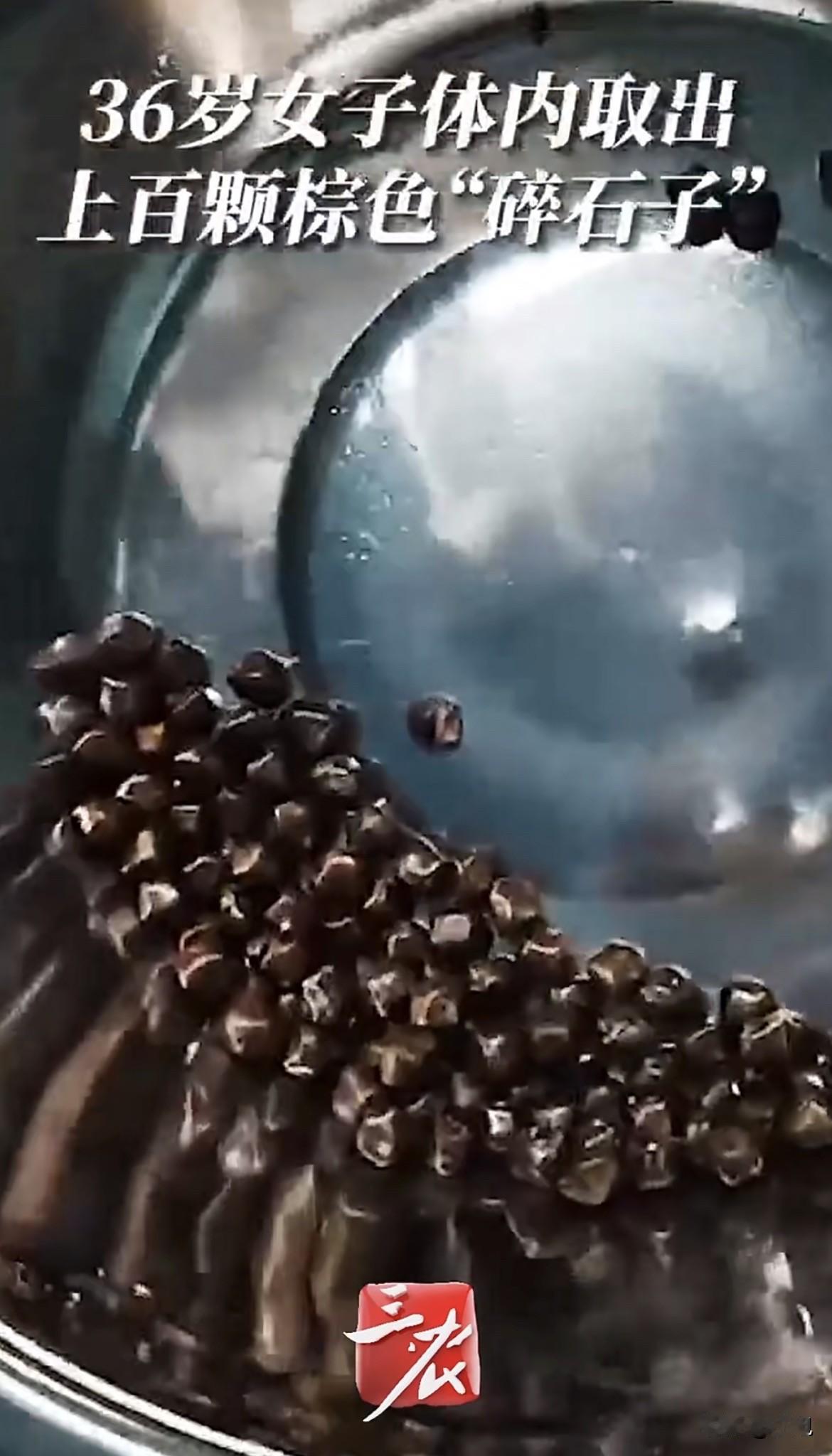 太吓人了，石家庄一位36岁的女士，最近做了一场手术。医生从她的胆囊里，取出了整整