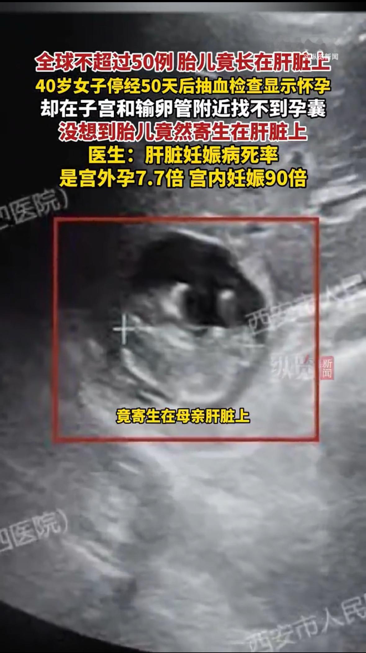 世界之大，无奇不有！怀了孕，胎儿没在子宫里，竟然在妈妈的肝脏上“安了家”。陕