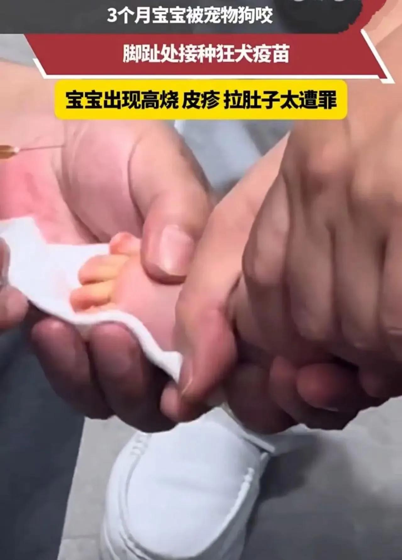 三个月宝宝被家里养了几年的狗咬了，小脚趾出血，狂犬疫苗立刻安排，后面又发烧、起疹