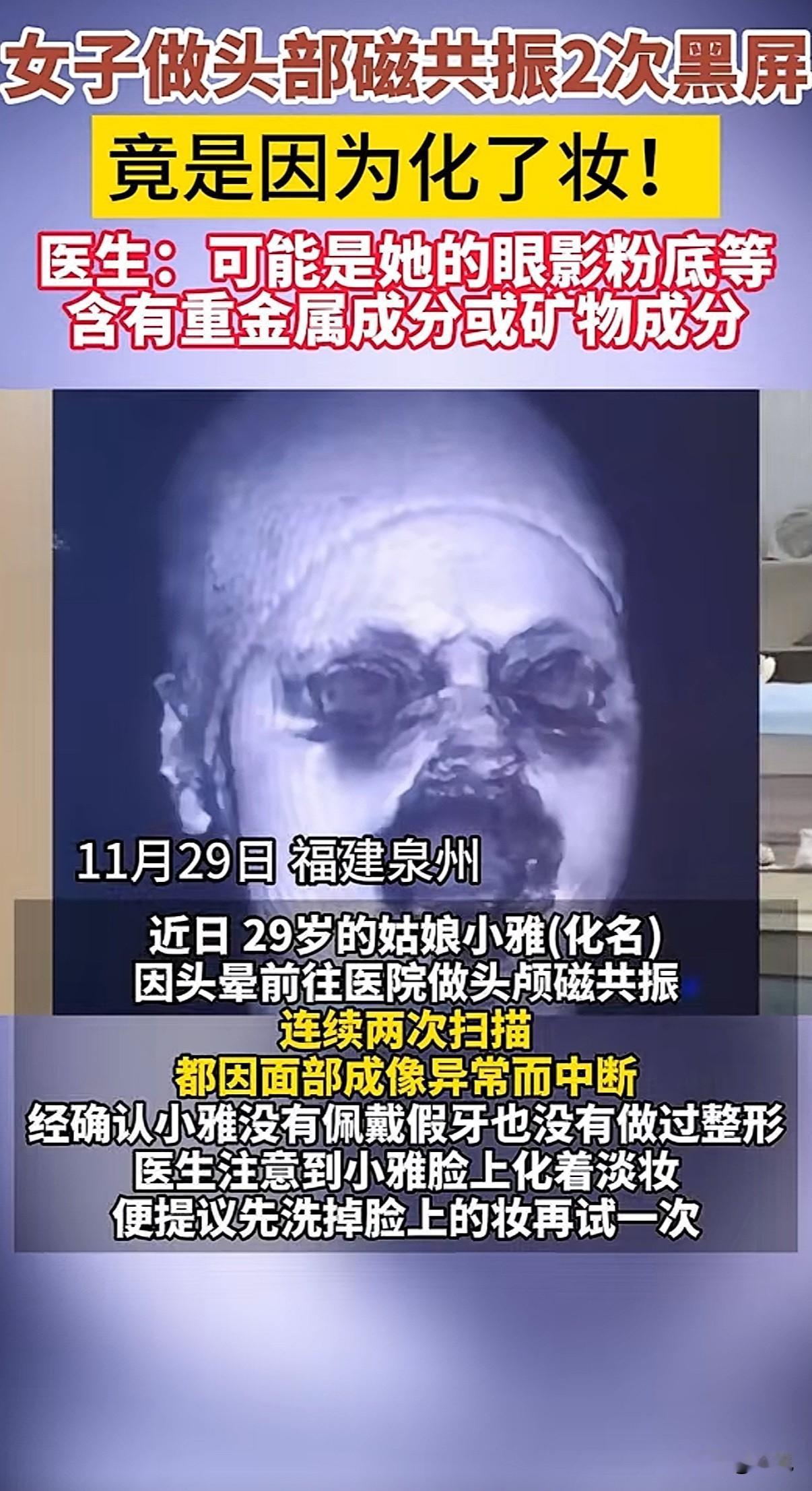 离谱！福建泉州，一个29岁的姑娘，因为老是头晕，去了趟医院。医生让她做个头颅磁共