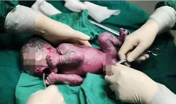 46岁产妇预产期过10天未发动, 医生紧急剖腹后, 产房臭味刺鼻熏天