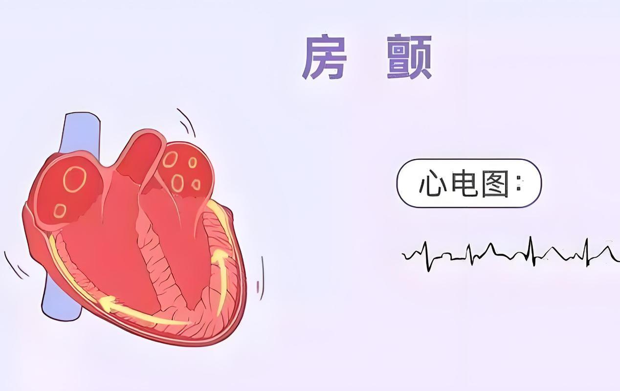 神经外科医生提醒：脑梗不管怎么治，最后都逃不过复发真的吗？脑梗复发的事，大