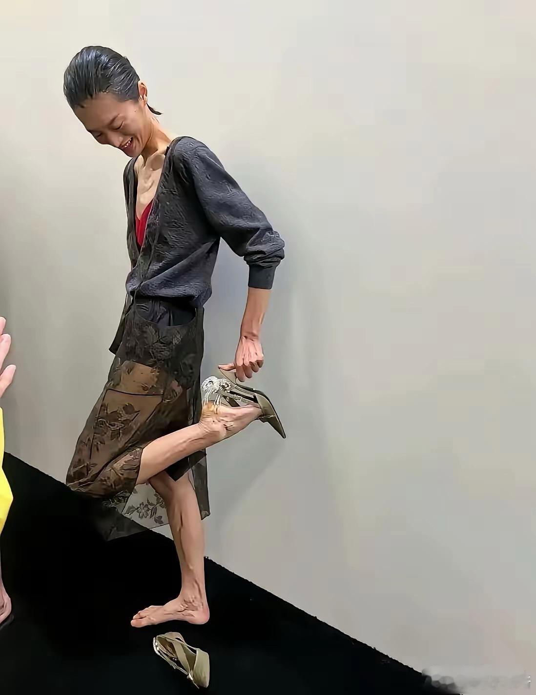 37岁的刘雯，瘦骨嶙峋的像73岁的老太太。四肢芊细，青筋暴出，一点肉肉感都没有，