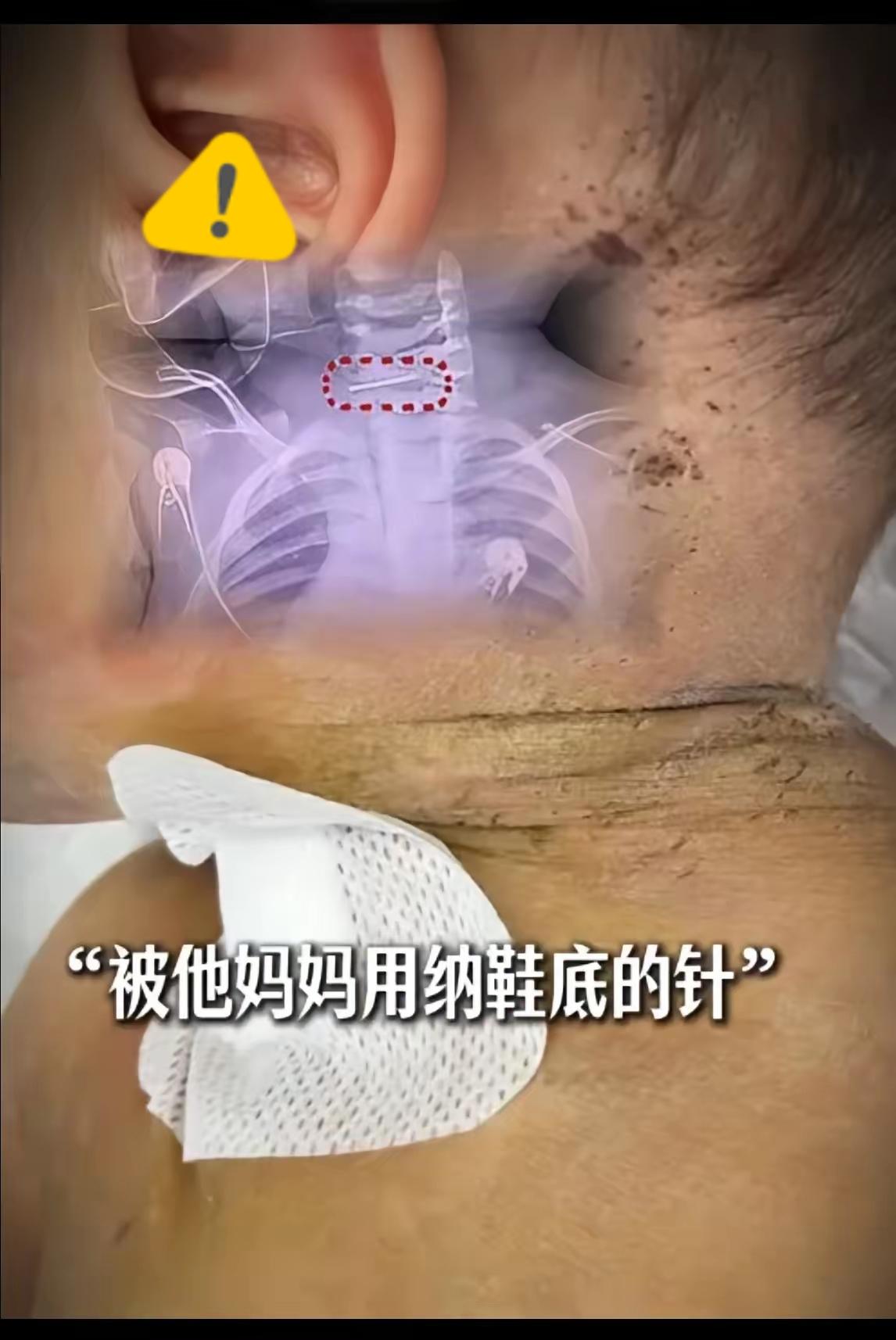 不是所有的人能好好爱孩子的你敢相信吗？10个月娃被亲妈用缝衣针扎，理由荒唐