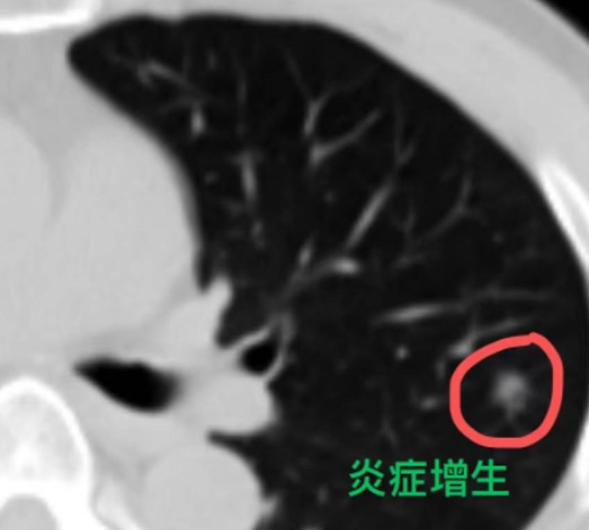 查出肺部微小结节，身体各种不适？很多人拿到体检报告，看到肺部有5mm以下的微小结