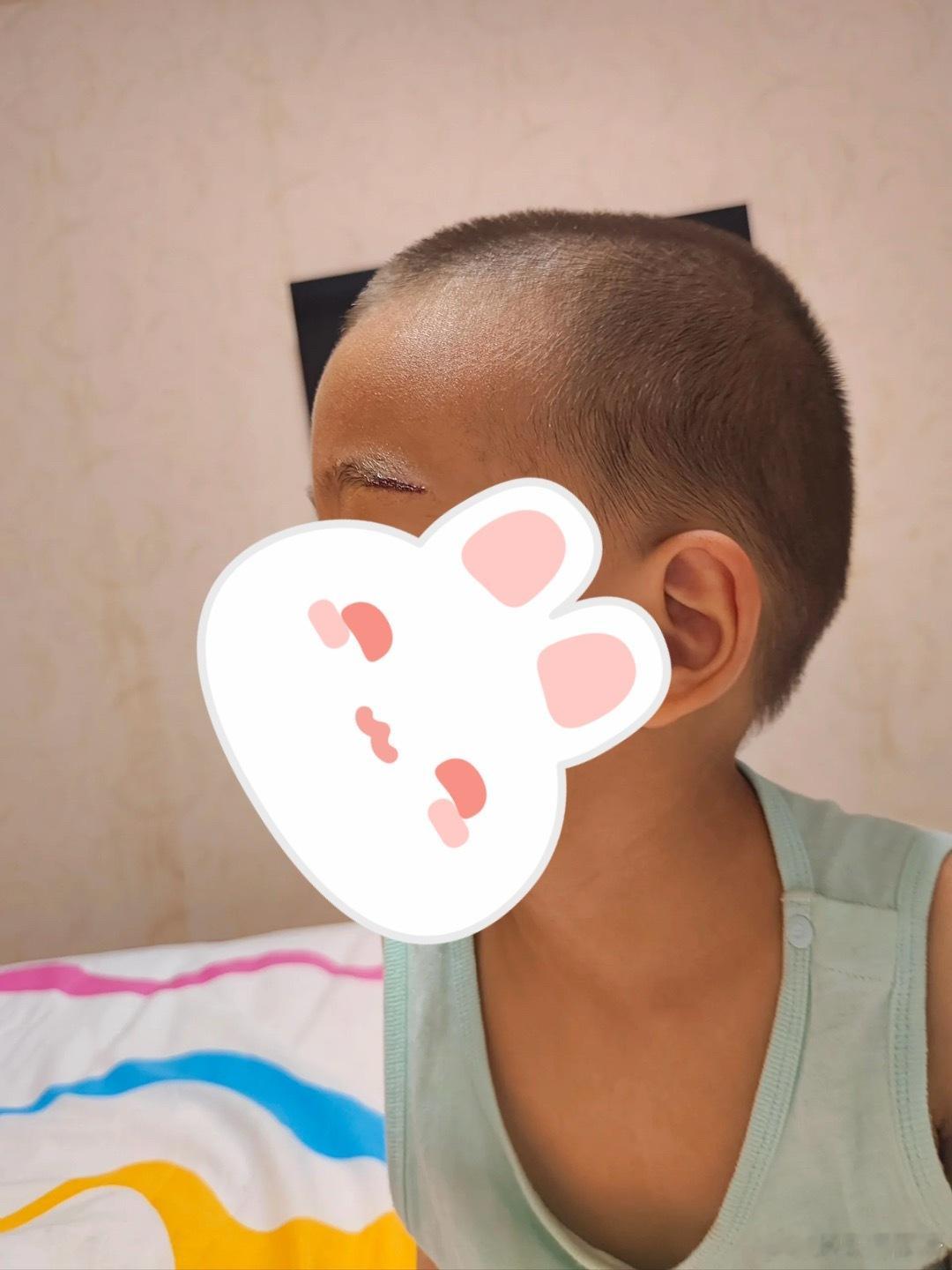 孩子眉下磕了个小口子，影响以后考公吗❓​​​