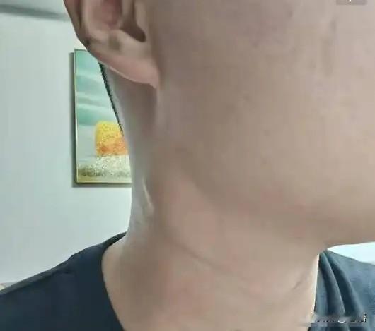 再年轻也没用！江西23岁徐平安去世，死因曝光，源头竟是一颗痣世事无常！近日