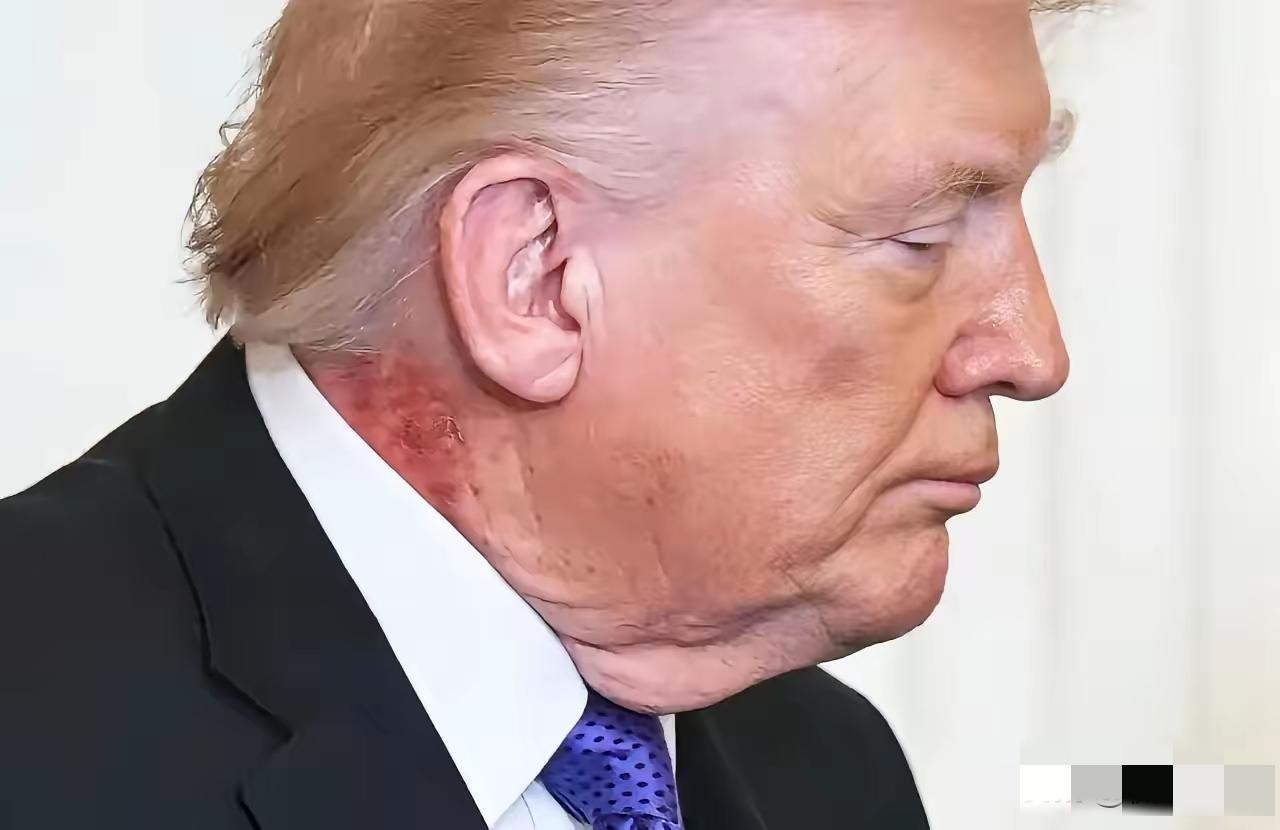 没看错，特朗普生病了，从裸露的皮肤可以看出，从脖子到手，都有瘀血的症状，有网友说