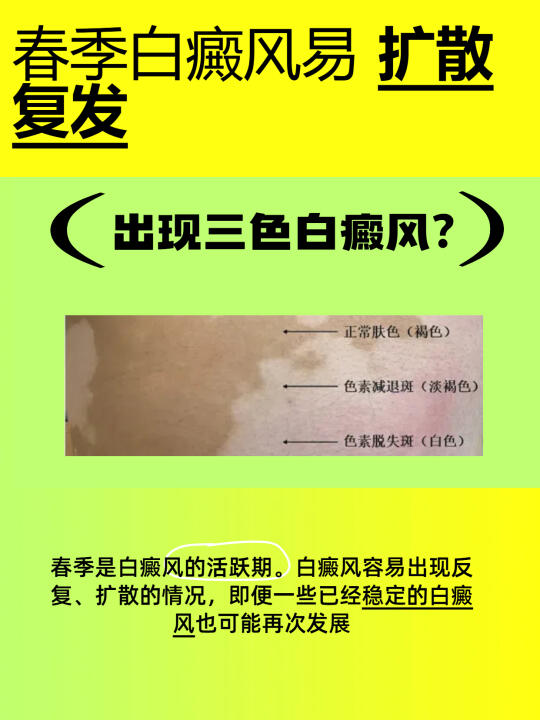 春季白癜风易扩散、复发，出现三色白癜风？