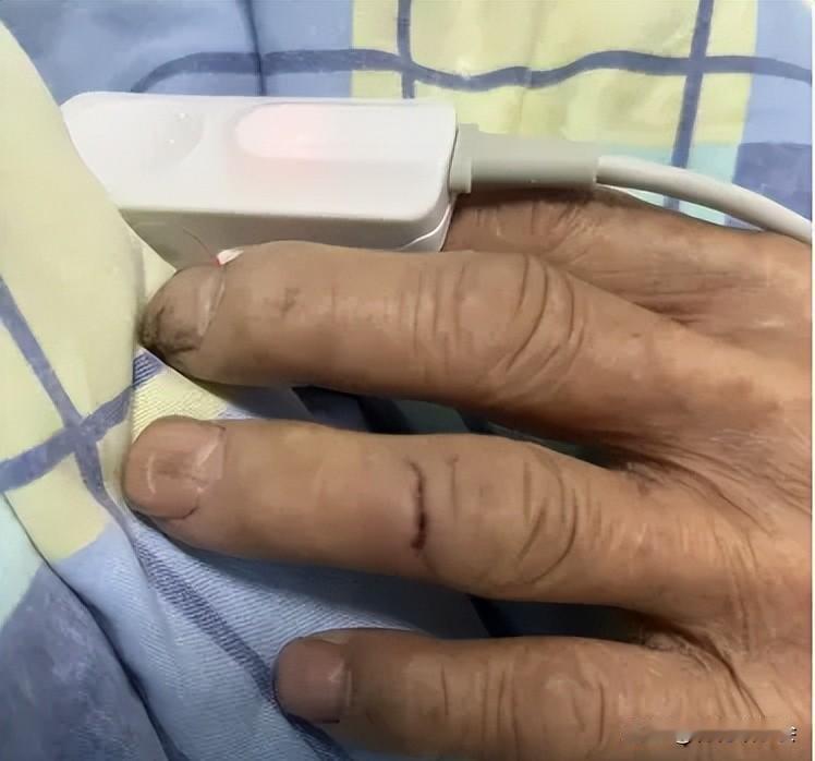 老鼠一口咬，致命悲剧生许多人觉得，小伤口不足为惧，忍一忍便会自愈，谁能料到，其