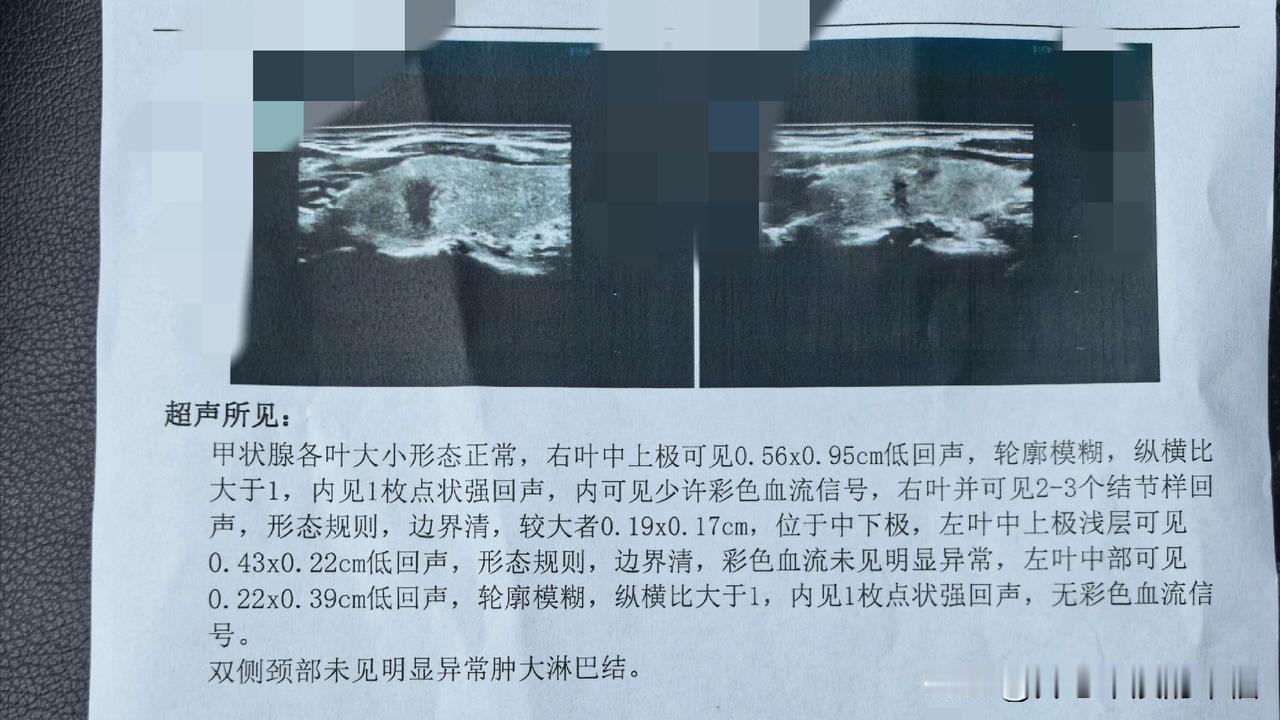 甲状腺结节4A。天塌了，去年还只有一个小结节，今年体检竟然长出了好几个，最关键的