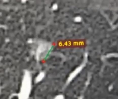 门诊来了一位53岁的大姐，一进门就挺着急的，手里攥着CT报告，上来就跟我说，想让