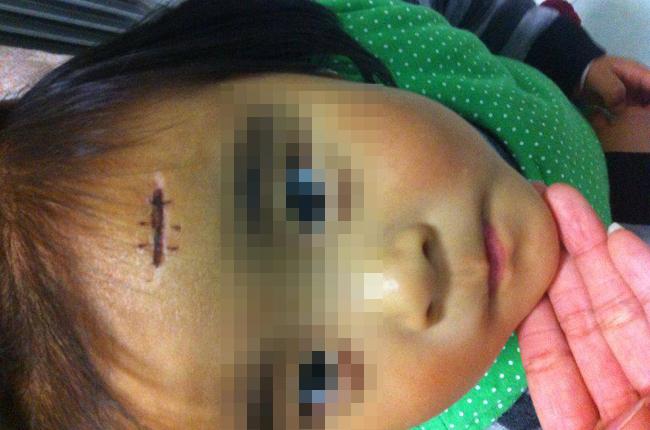 3岁宝宝看小猪佩奇, 模仿一个动作, 缝了三针! 妈妈感到后怕