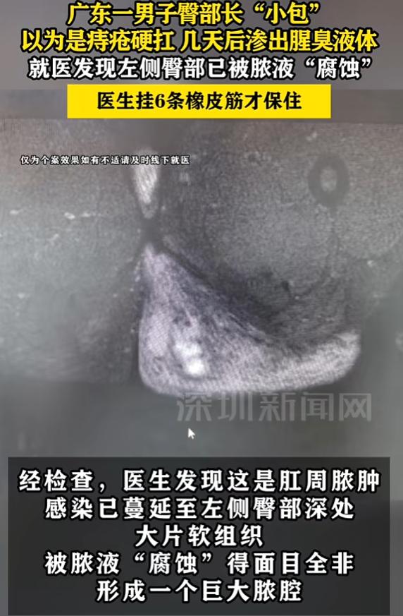 “悲剧还是发生了！”9月12日报道，广东东莞，一男子屁股上长了个小硬块，他以为是