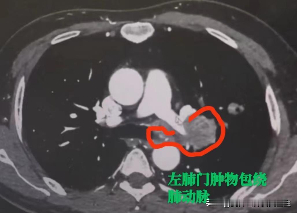 从咯血到重生！3次化疗+免疫治疗，这台肺癌手术让我激动坏了！老李今年54岁，是单