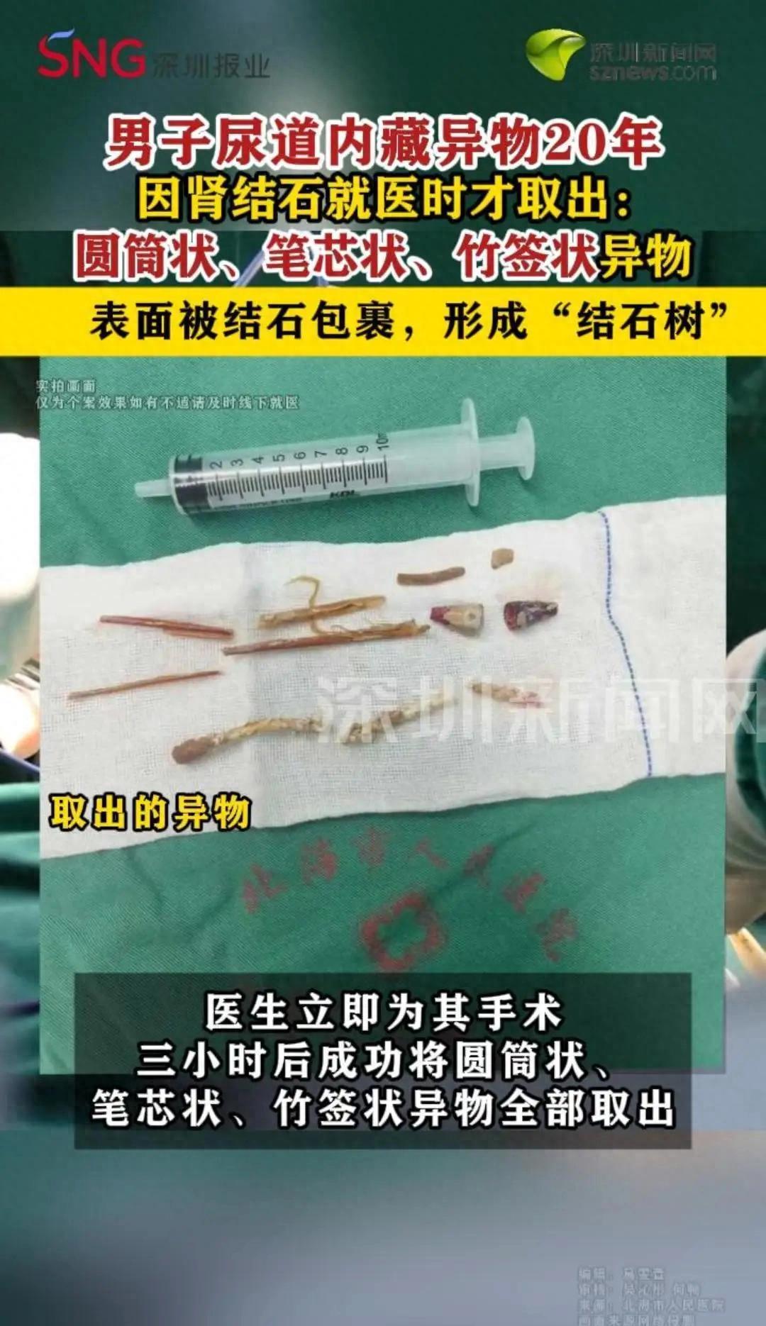 男子尿道内藏大量异物20年，惊呆医生最近，北海市人民医院上演一场惊险的拆弹大