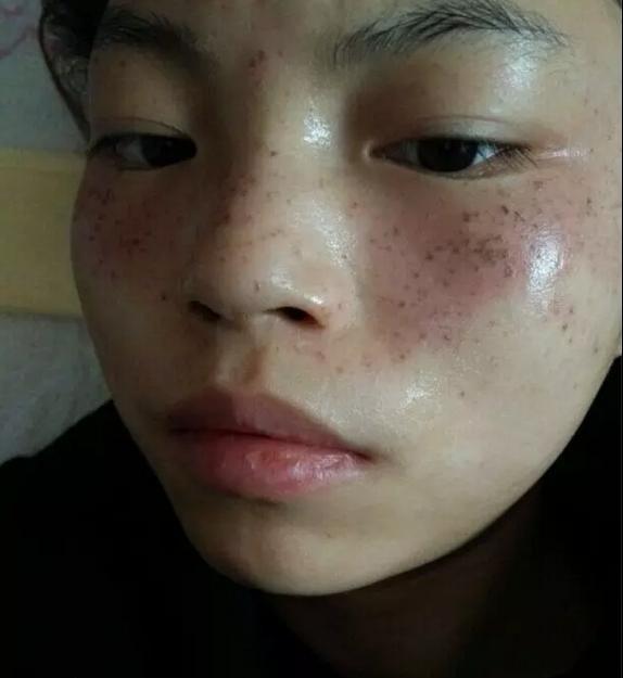 睡前用“他”洗脸, 盆里滴上两滴, 三分钟祛斑, 皮肤光滑雀斑消失