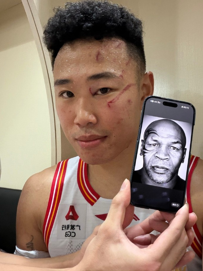 贺希宁晒脸部伤痕对比拳王泰森: 如果这是赢球的代价 我愿意