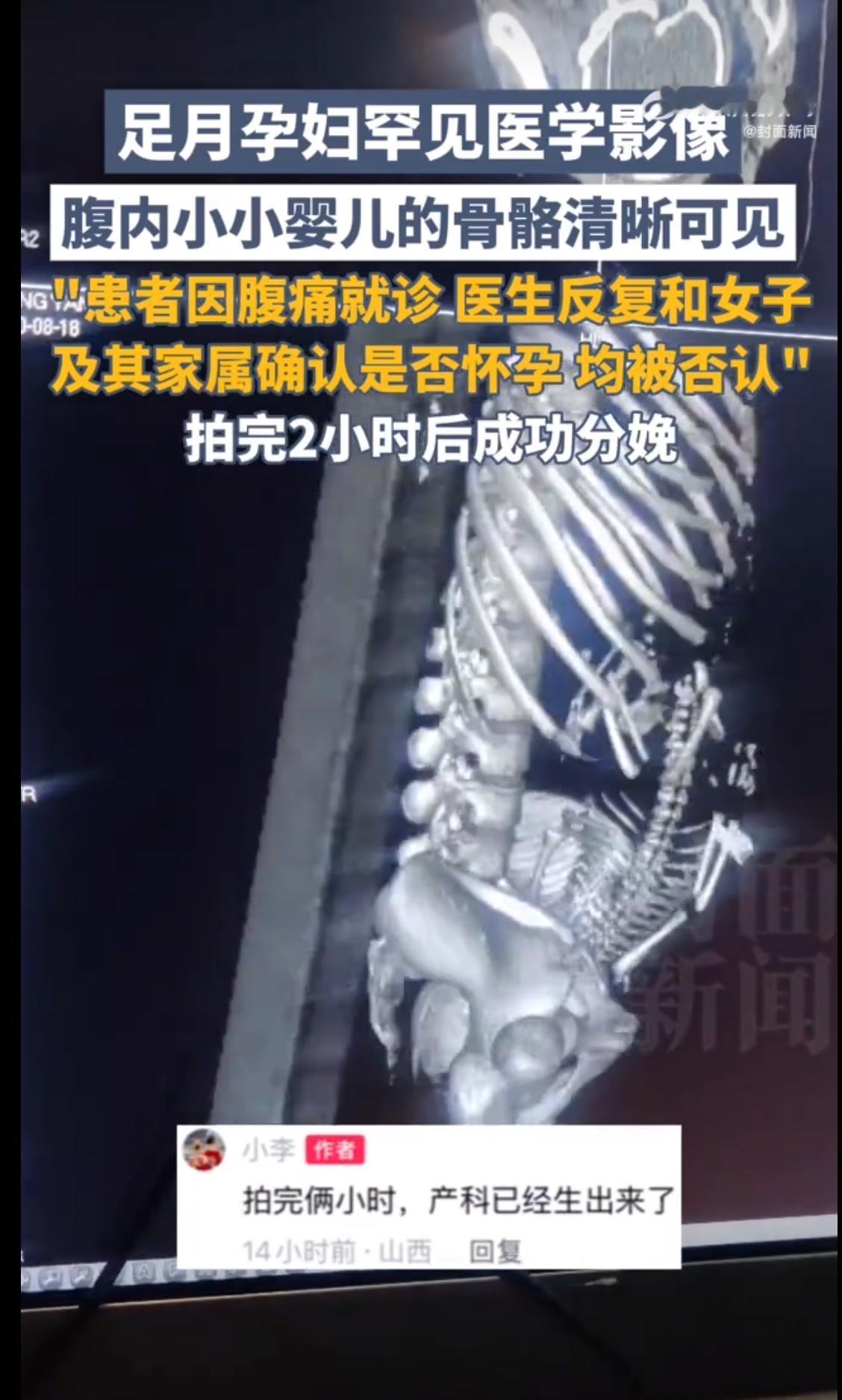 前几天刷到个新闻，心里揪得慌。杭州一个19岁姑娘，肚子疼得厉害，去医院一查，医生