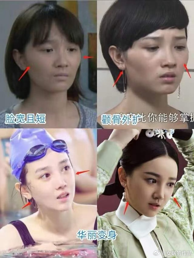 陈小纭已经是完全认不出的程度了，她曾在节目上自曝做过将近10次整骨，“脸真的小了一圈，但是非常疼，每