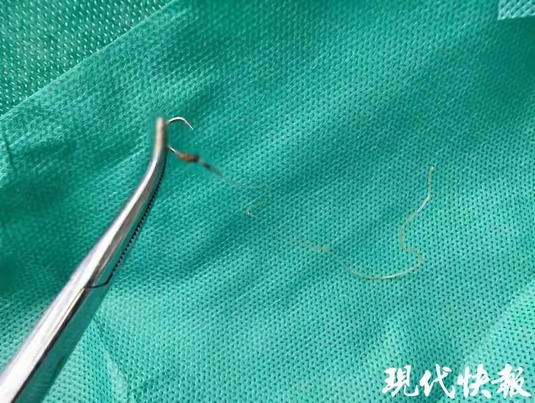 “太吓人了！”江苏一位59岁女子肛门刺痛，用手去摸摸到一根线，想也没想直接一拉，
