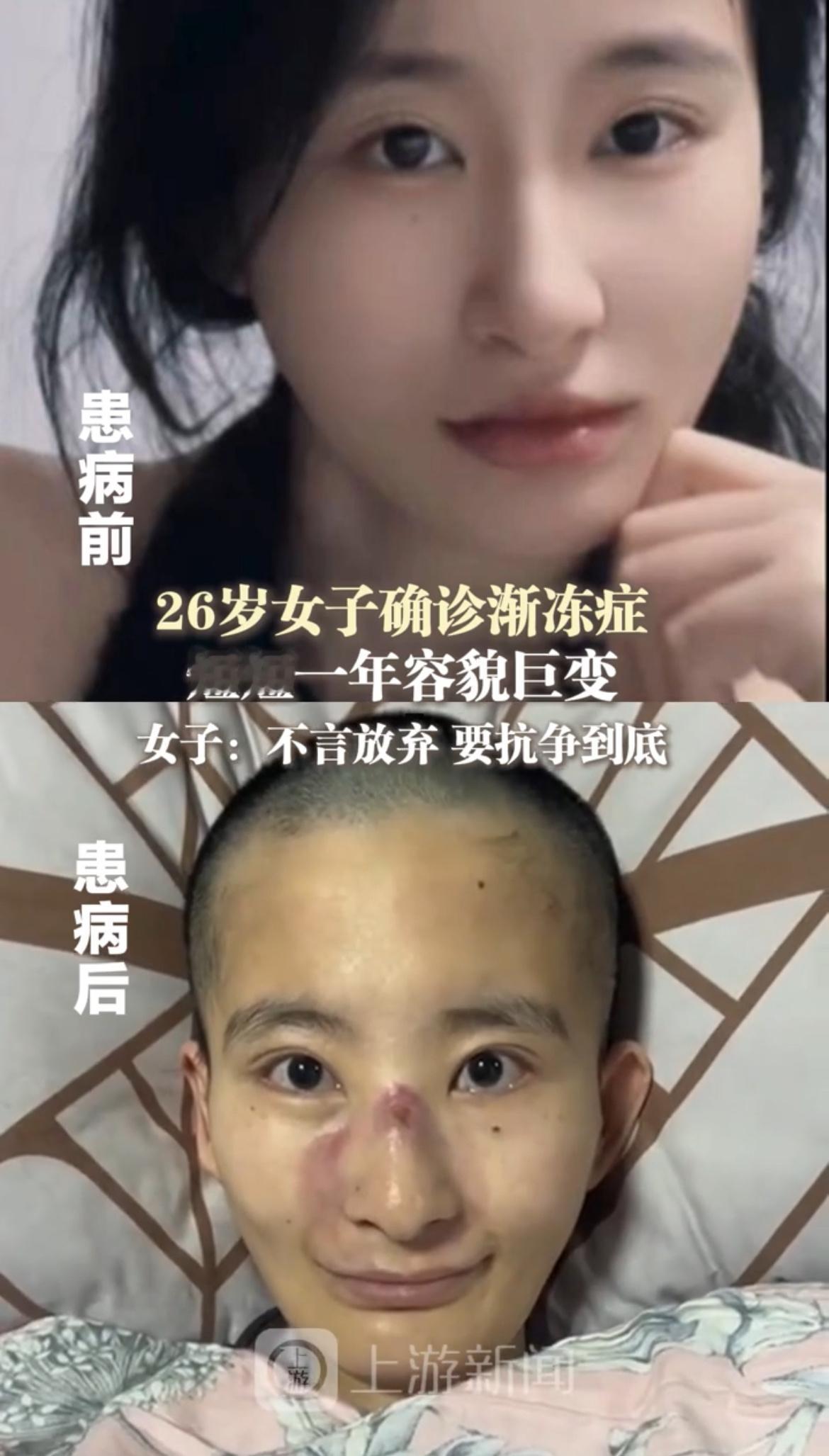 女生确诊渐冻症一年容貌巨变湖北有一个医生也是得了渐冻症，但是他没有用西医思维去