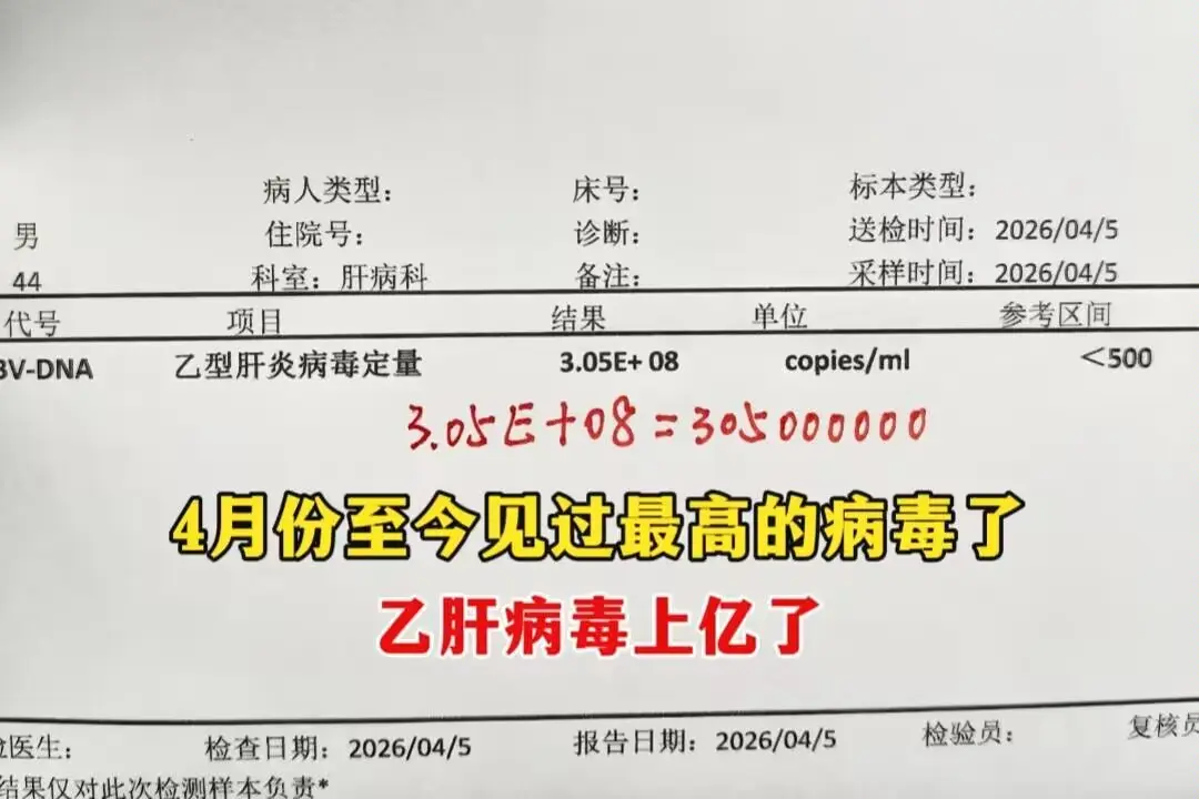 上亿的病毒量确实危险比较大，我的这位患者很忧虑。因为之前的治疗时病毒已...