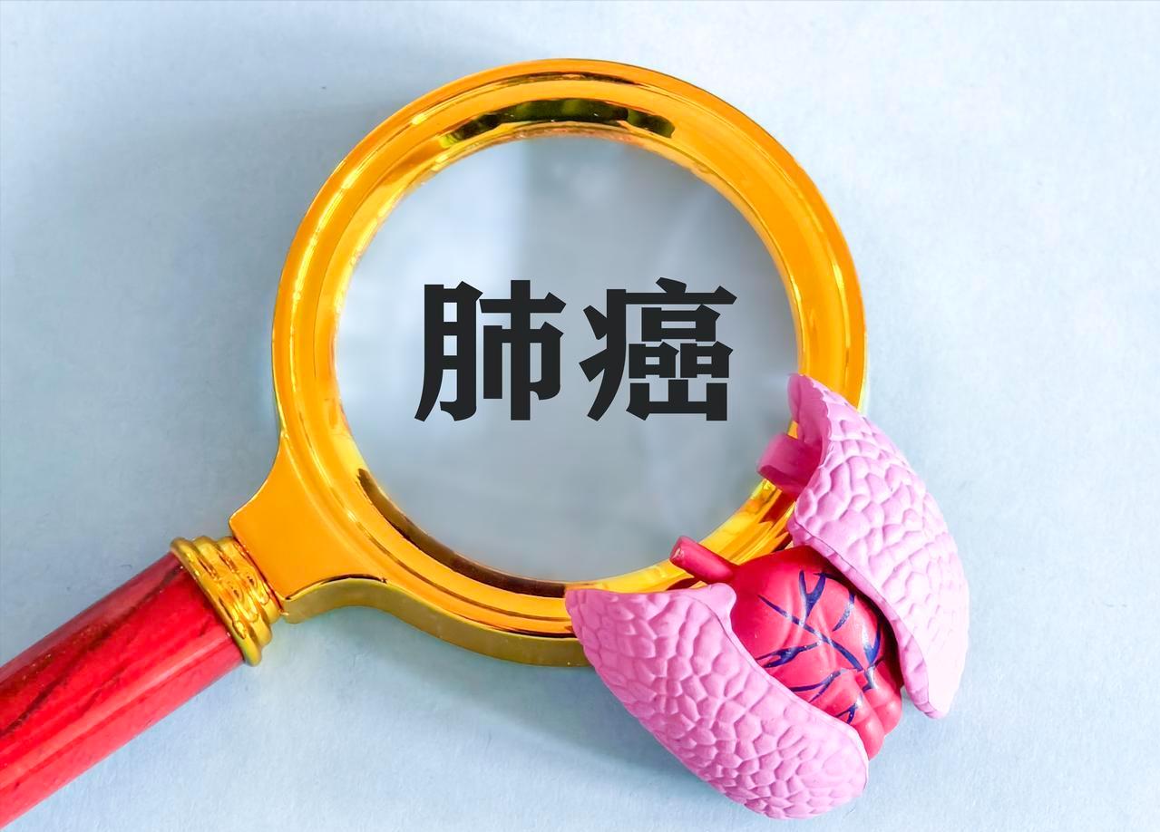 如何早期发现肺癌，有几个容易判断的点，一定要注意监测变化早期肺癌一般没有感觉和