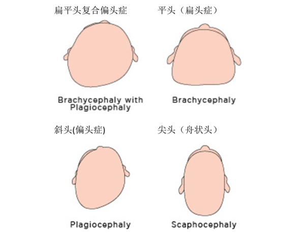 育儿说 小孩的头型真的是月子里睡出来的吗 听过来人怎么说