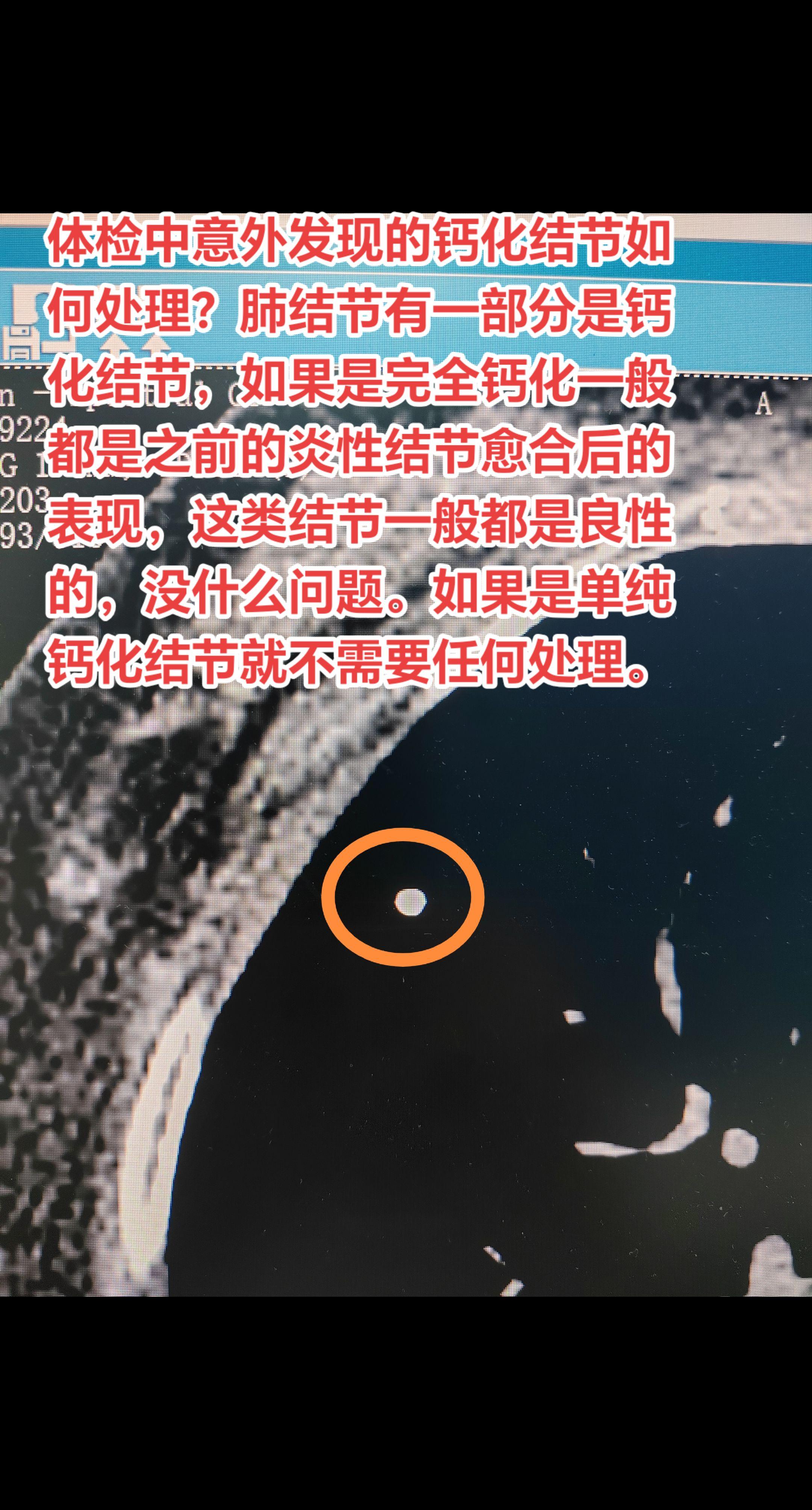 体检中意外发现的钙化结节如何处理？肺结节有一部分是钙化结节，如果是完全...