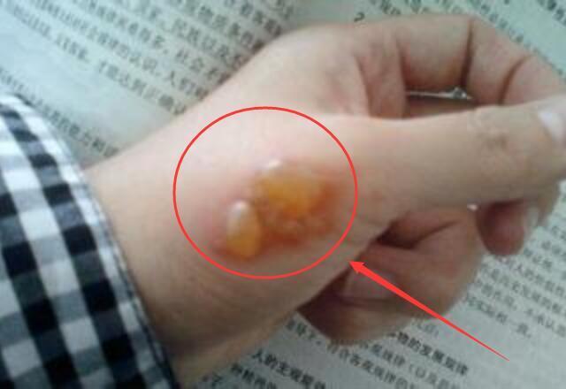 被开水烫伤的5字应急治疗方法你知道吗?