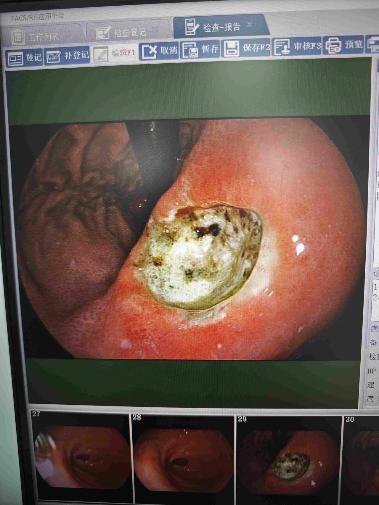 50多岁男性，胃胀2个月，进食后明显，一直口服奥美拉唑，症状时轻时重张叔五