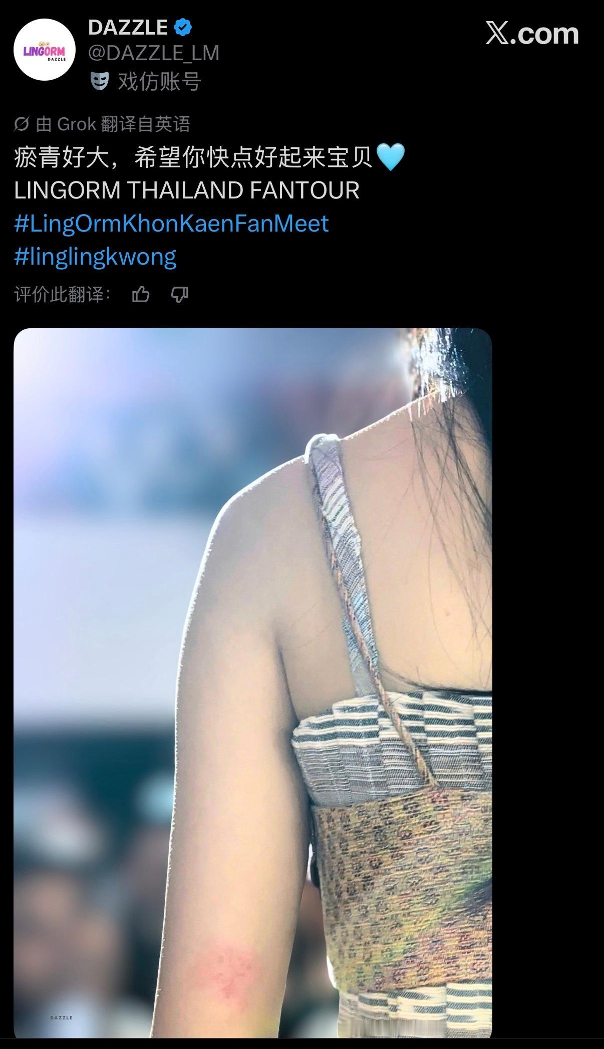是淤青还是过敏🥺