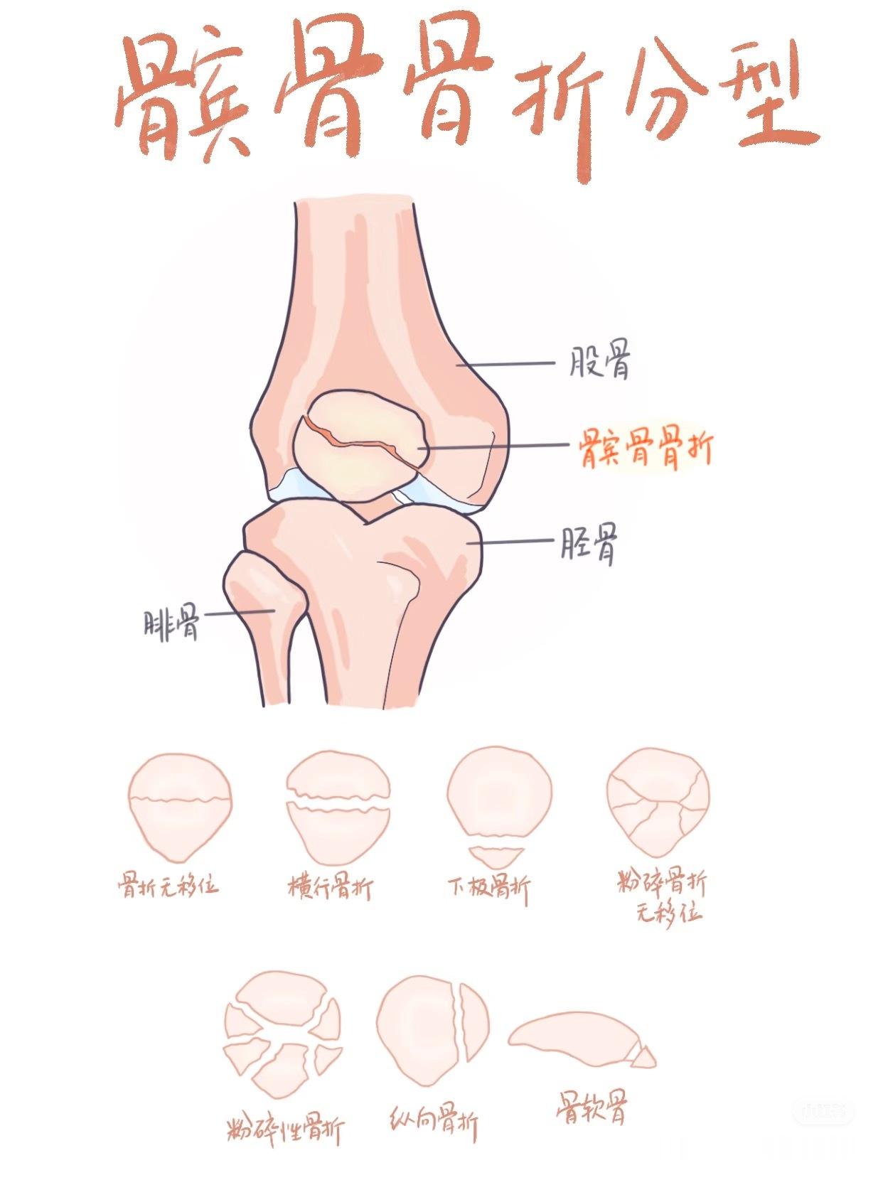 膝盖疼痛提到髌骨，大家应该都会想到髌骨软化，今天咱们讲另一种髌骨损伤——髌骨骨