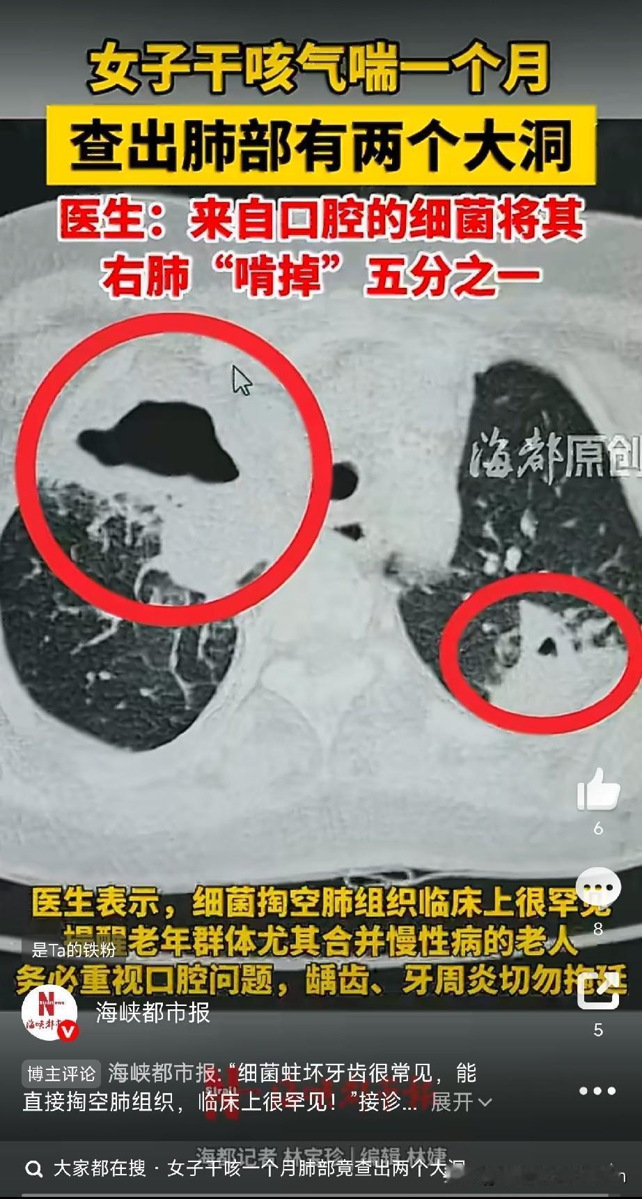 口腔细菌吃掉女子肺部组织福建71岁的林阿姨，干咳气喘一个多月，抗生素止咳药吃