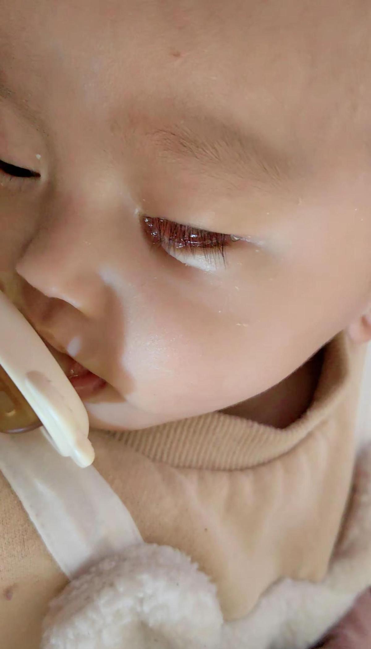 宝宝一出生就长了红疙瘩，吓坏爸妈。这玩意儿叫血管瘤，不是因为妈妈吃错啥，也不是