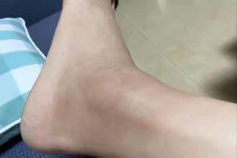 心不心衰，看脚踝就知道？心内科医生：脚踝这个变化可能预示问题——但请先认清：“