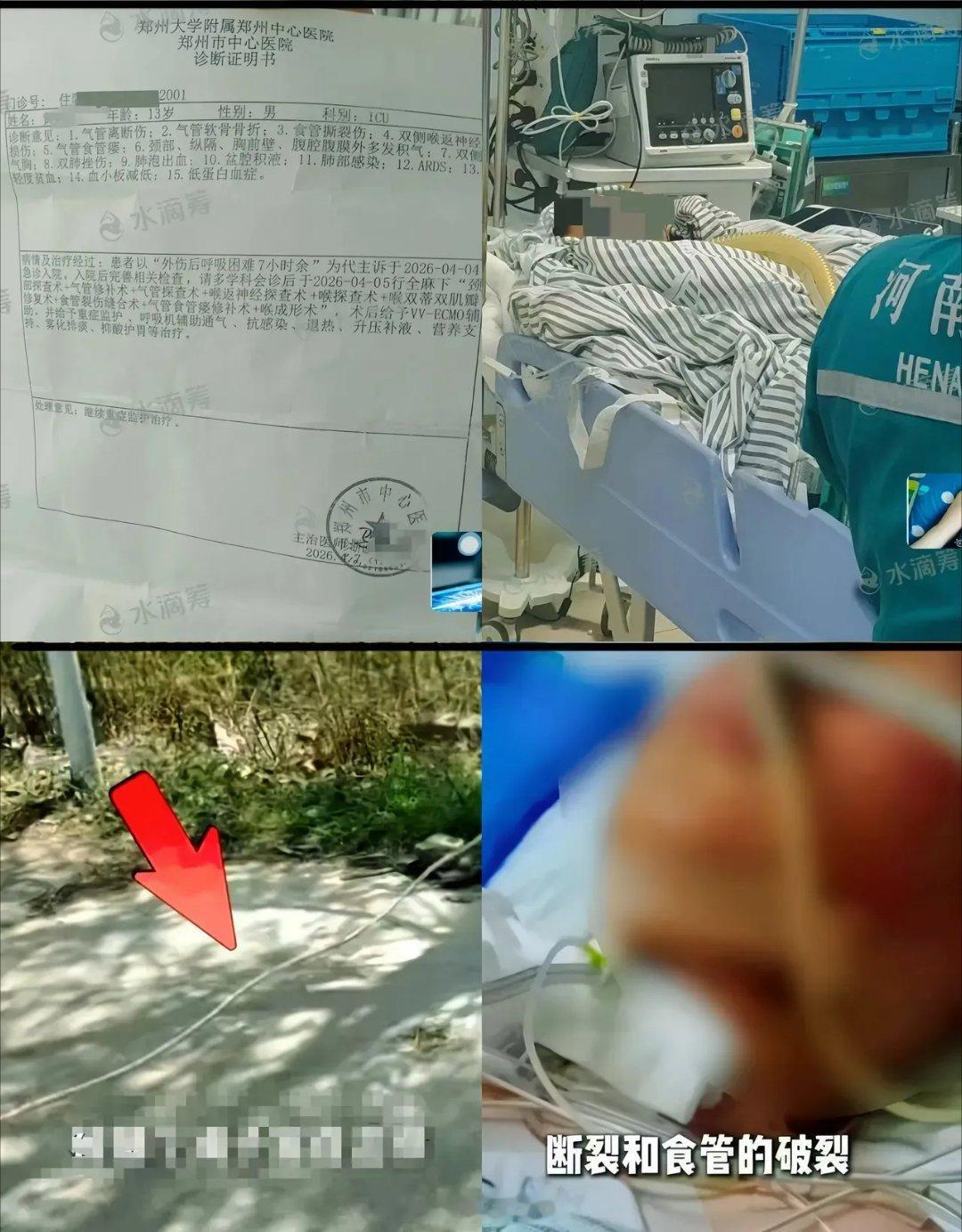 万幸！被绳索割喉男孩脱离危险，最新后续来了🙏经过全力抢救，孩子终于保住性命，已