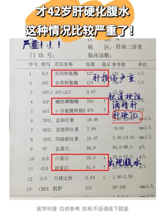 才42岁肝硬化腹水，这种情况比较严重了！ 不得不说，今天一天接诊了6例...