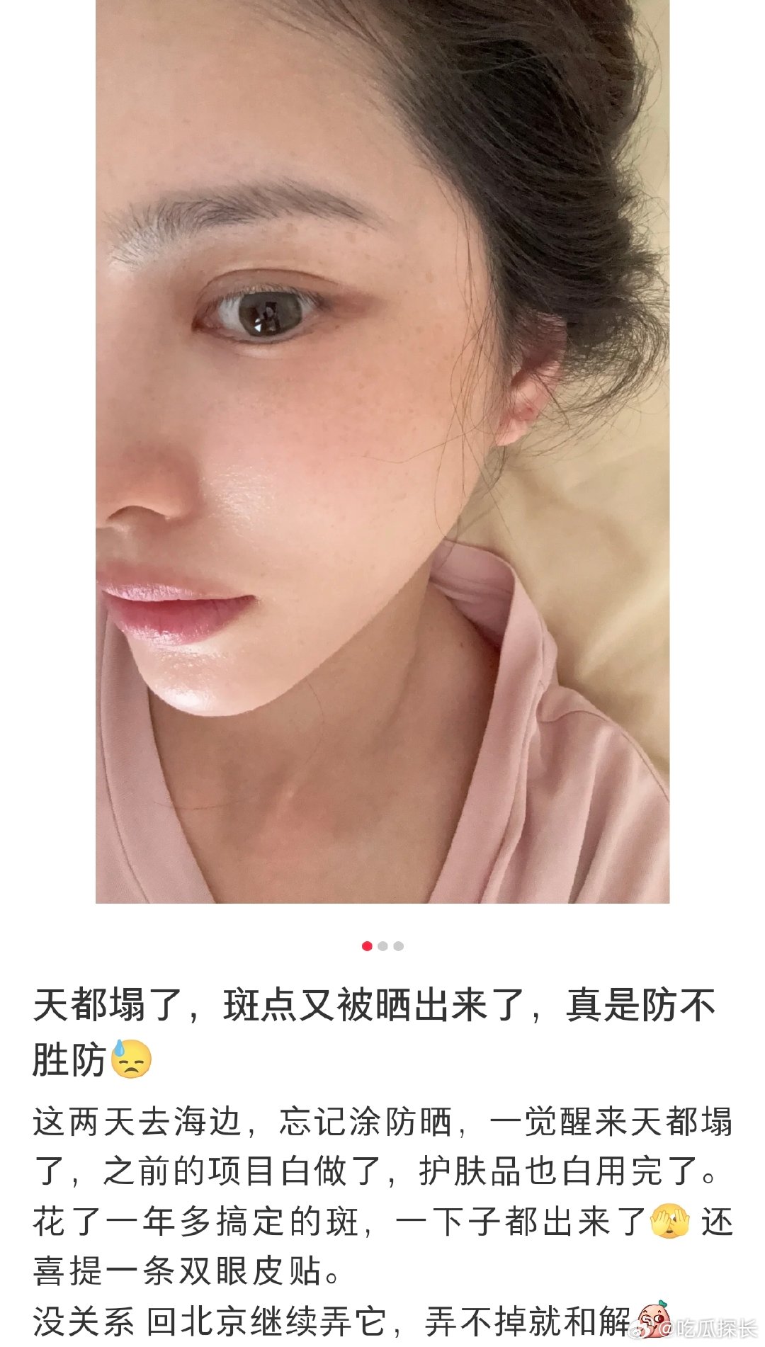 王灿旅游晒出雀斑王灿海边忘记涂防晒，雀斑直接“集体出逃”啦～不过咱就是说，有