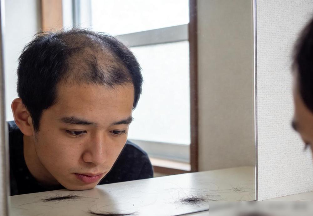 别再甩锅给爹妈的基因了，你那地中海基本都是自己玩命作出来的。三十来岁的当打之