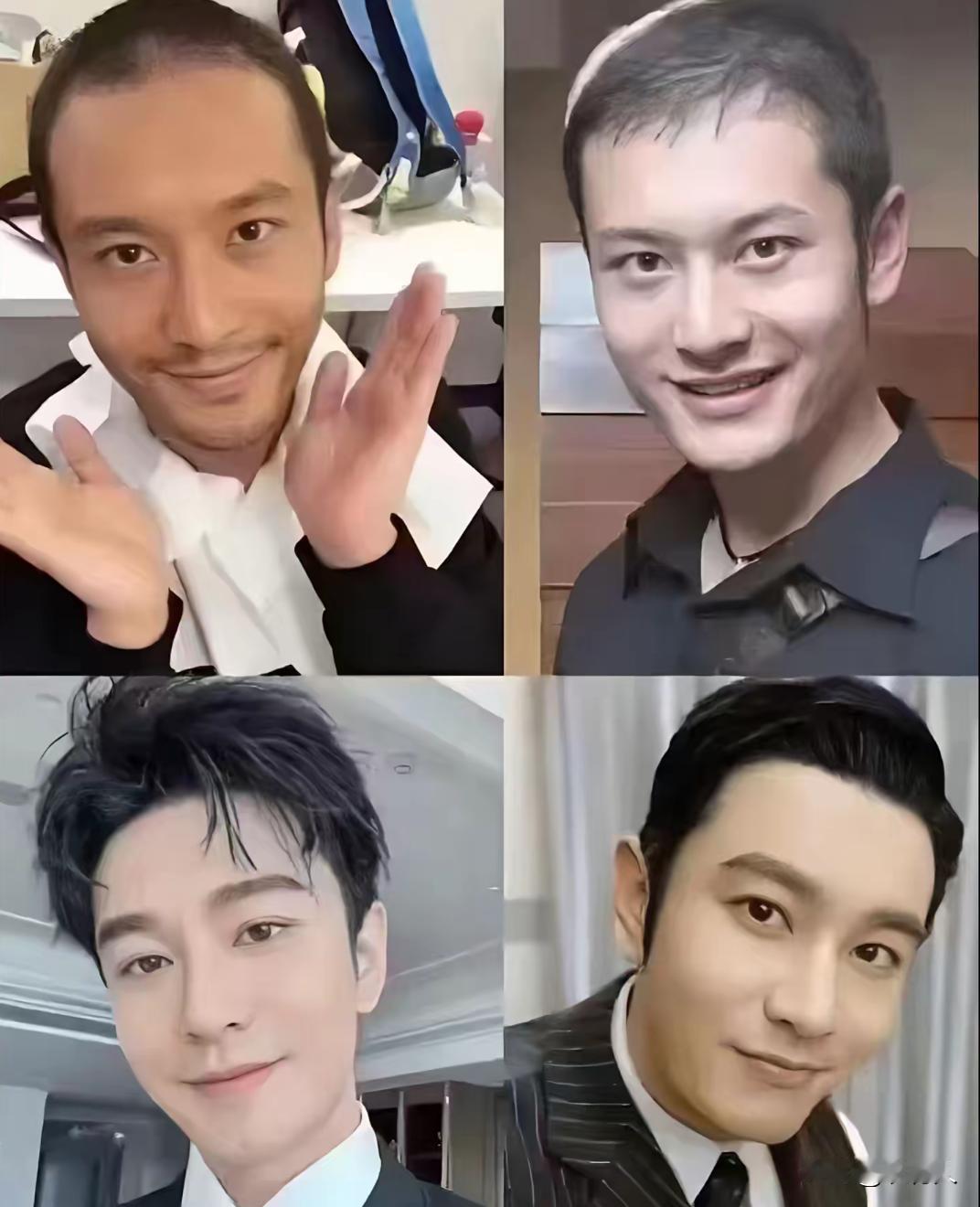 之前黄晓明是秃顶，也不知道他用的什么方法？头发现在这么茂密了，治疗秃顶你们有什么