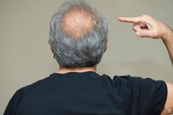 凤凰新闻【寿命长不长，头发先知？医学发现：60岁后，白发少的人更长寿？】有些人年