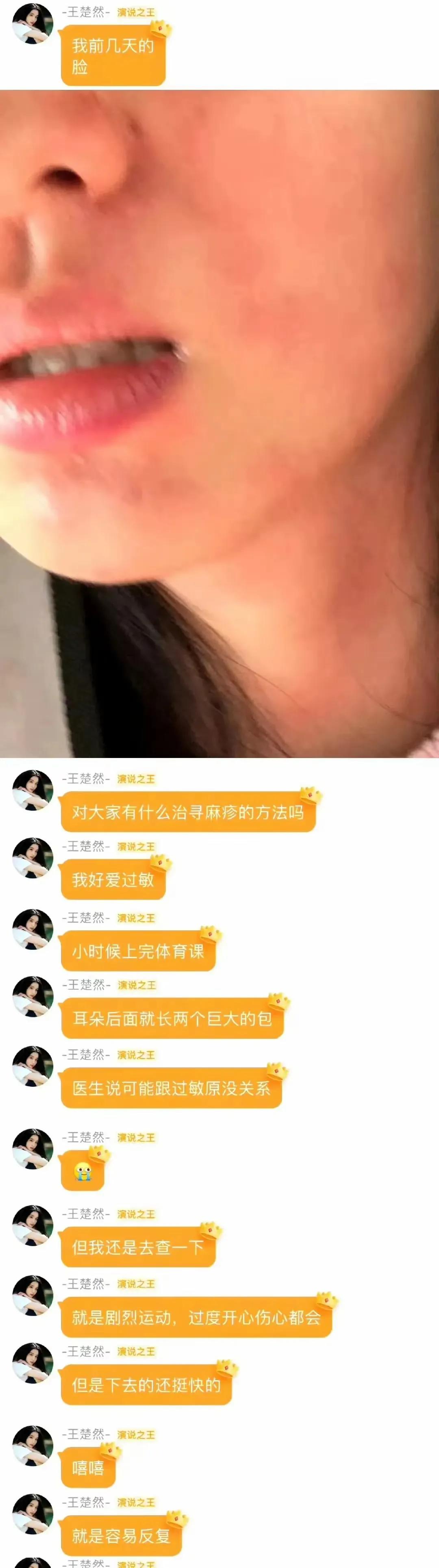 王楚然自曝荨麻疹痛苦崩溃！网友炸锅：痒到想把皮挠掉！26岁当红女星王楚然近日