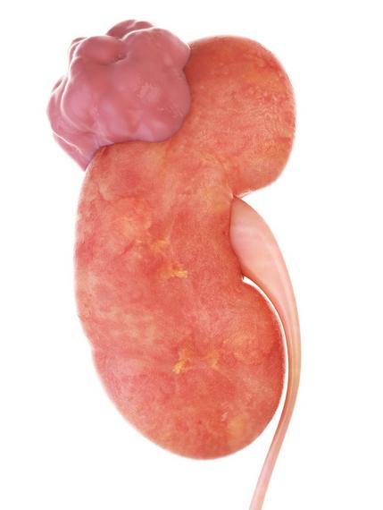 谁说肾囊肿消不了的？我治了30余载这病，信心满满投身泌尿外科领域30多年，我