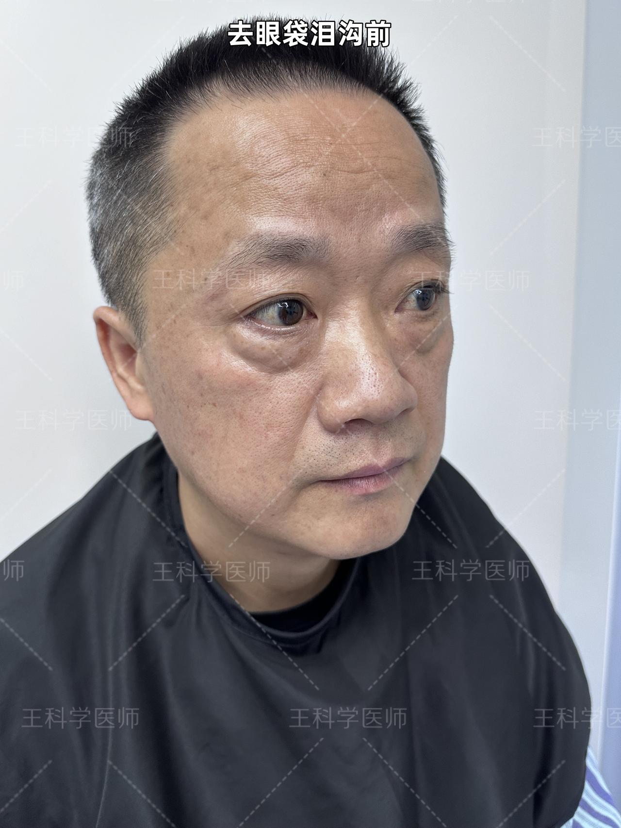 浅谈眼袋的事儿老人的眼袋宛如岁月馈赠的“勋章”，难以避免。随着年