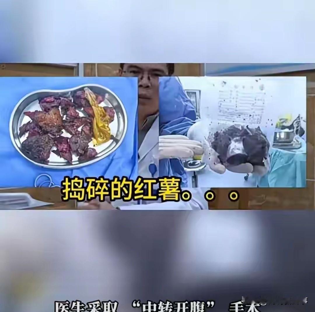 成都这事儿太离谱！61岁大爷深夜剧痛就医，竟是17cm红薯卡肛门取不出！男