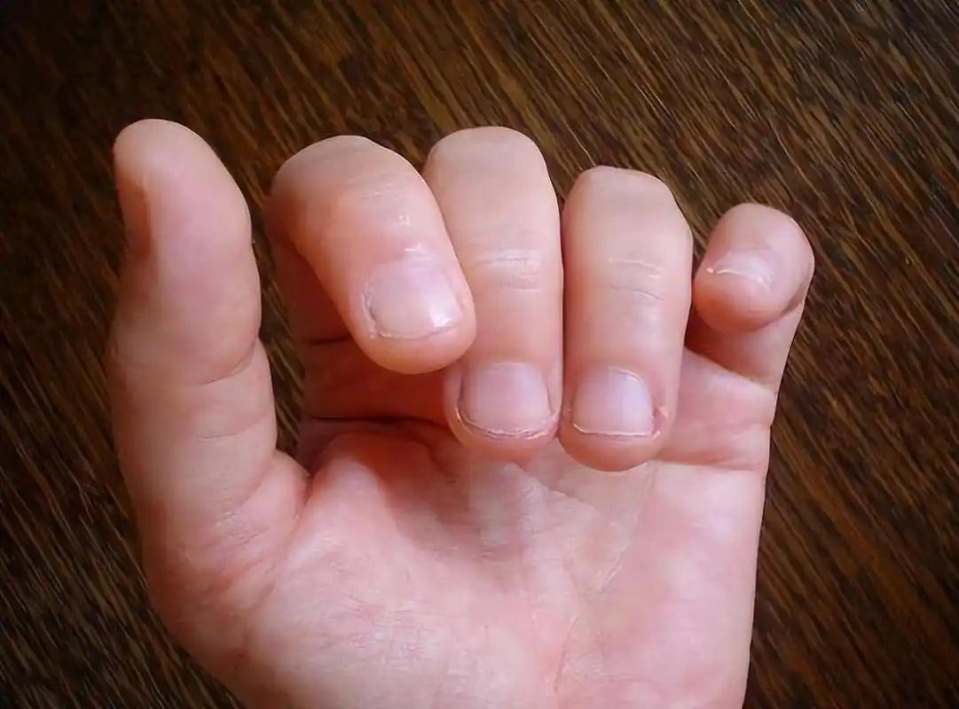 为什么有人指甲上有月牙，有的没有？竖纹指甲又是怎么回事？指甲这方寸之地，藏着不